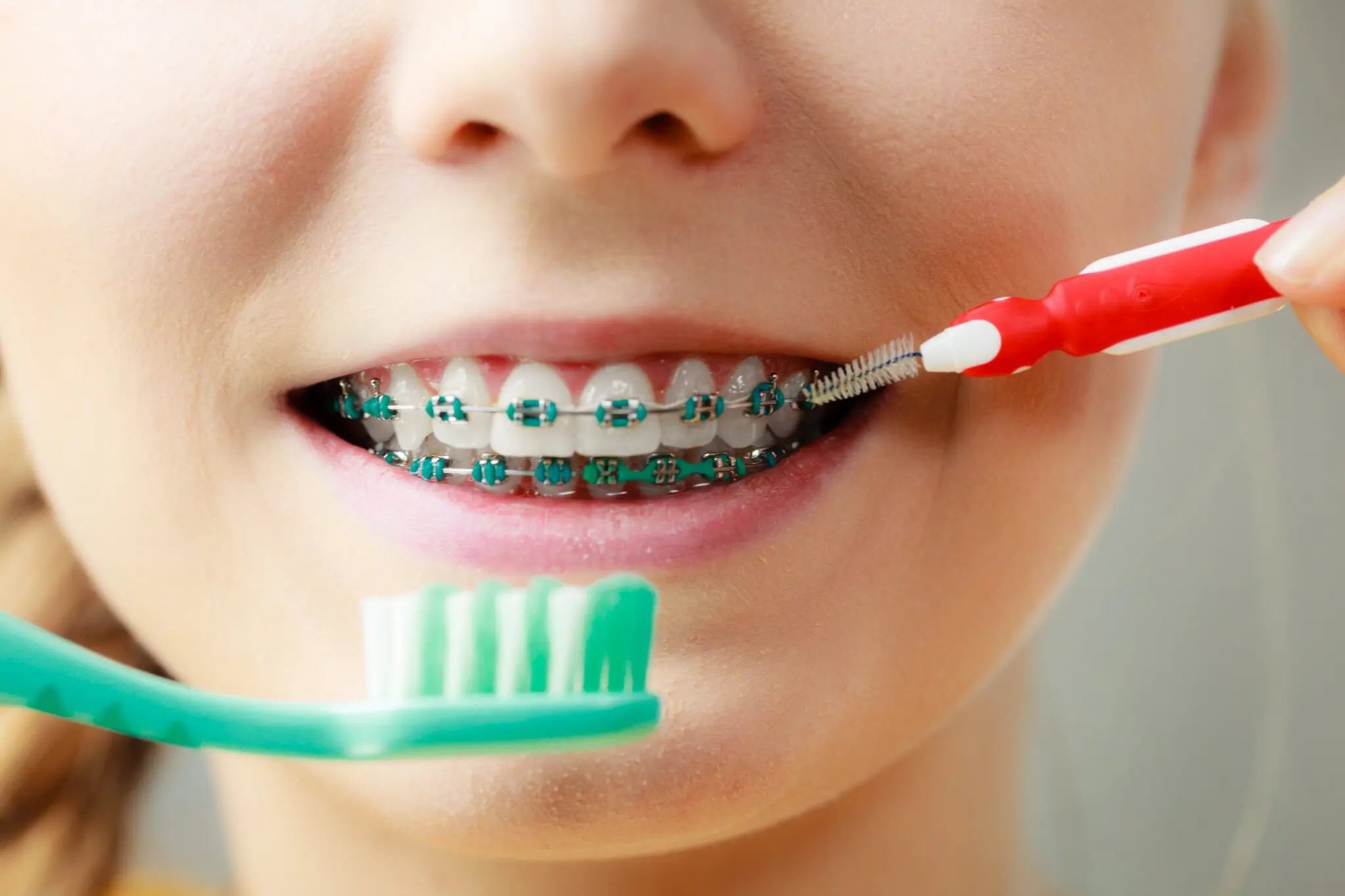 A person with traditional braces cleans their teeth with a toothbrush and interdental brush. Orthodontic care may be available in Henderson, NV.