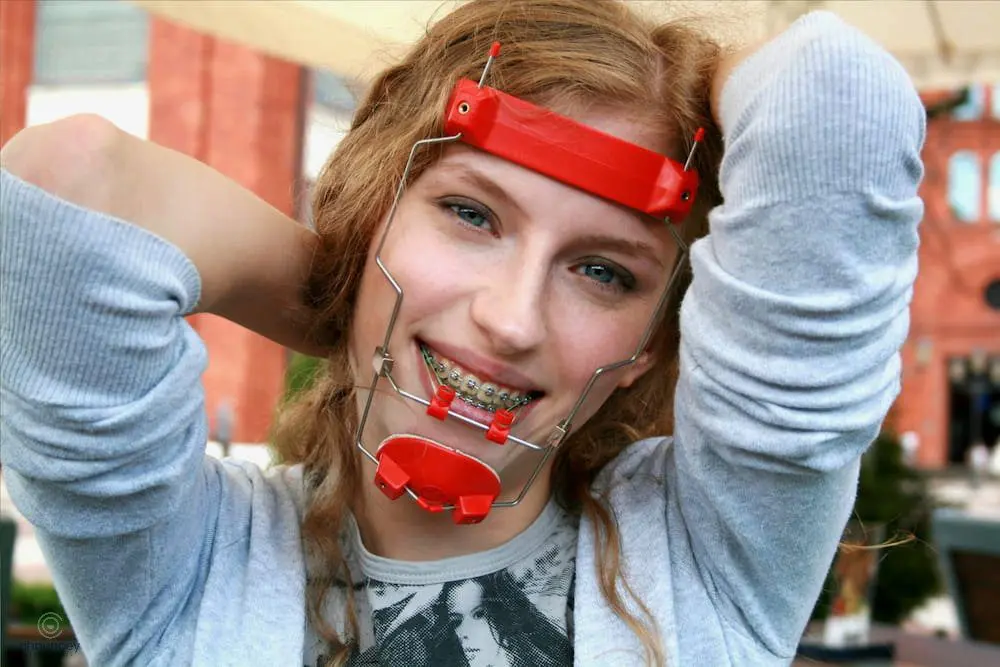 a woman posing at the camera reverse pull headgear braces in Henderson, NV A young person with braces wears a red orthodontic headgear appliance and smiles at the camera, arms raised behind their head in Henderson NV.