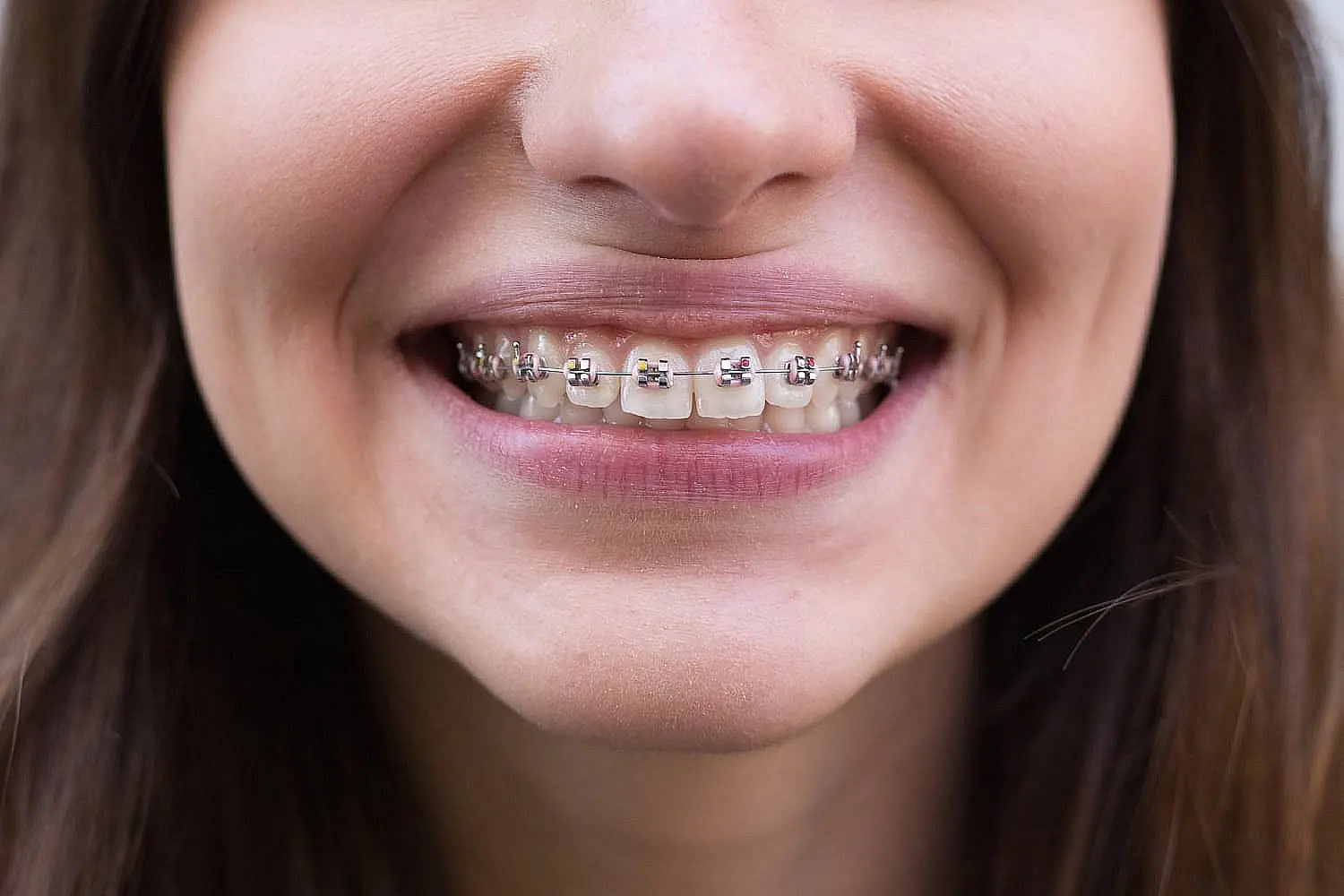 A close-up image shows a person with braces and slightly parted lips, subtly hinting at an overbite, treated at Chauncey Orthodontics
in Henderson, NV.