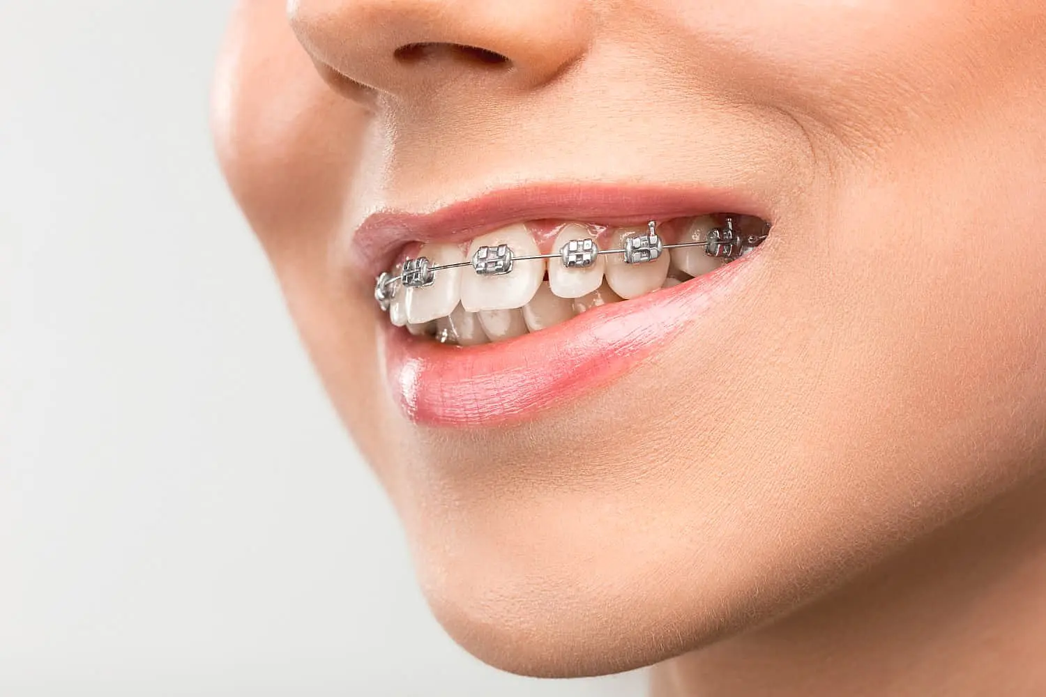 A close-up shows braces expertly aligning teeth and correcting an overbite at Chauncey Orthodontics
in Henderson, NV.