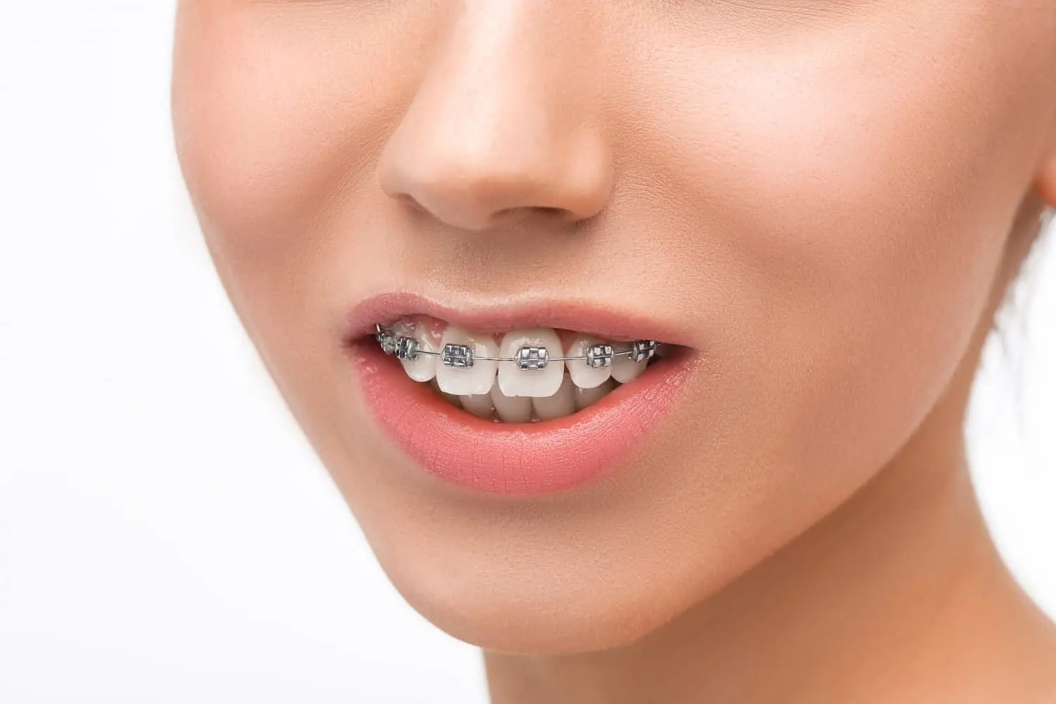 A person with braces working on an overbite, slightly smiling. This image represents the expert care at Chauncey Orthodontics
in Henderson, NV.