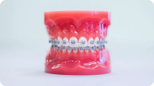 Displayed against a plain light background, this dental model showcases the structure and appearance of metal braces used in orthodontic treatment at Chauncey Orthodontics in Henderson, NV.