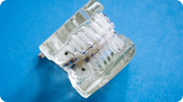 A clear dental model displays teeth with metal braces against a blue background at
Chauncey Orthodontics in Henderson, NV.
