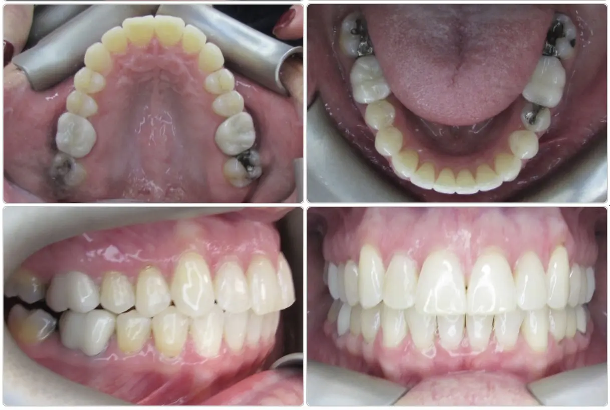 Four dental images showing upper and lower arches, and side and front views of teeth, with dental retractors in place and visible dental restorations.