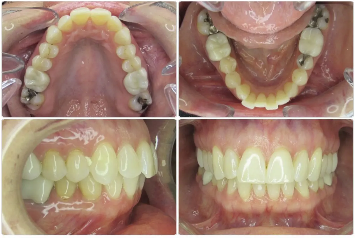 Four dental images show upper, lower, and side views of a person's teeth, highlighting alignment and dental work inside the mouth.