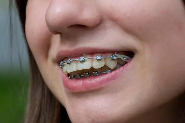 Close-up of a smiling patient showing metal braces on teeth – braces for overbite in henderson, nv.