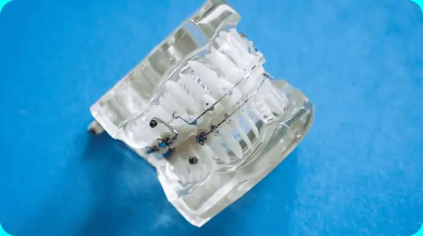 A clear dental model displays teeth with metal braces against a blue background at Chauncey Orthodontics in Henderson, NV.