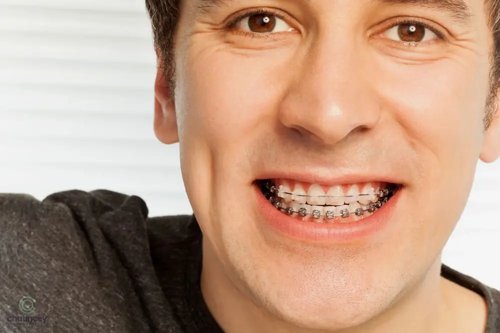 A close-up of a smiling man wearing metal dental braces on his upper and lower teeth, highlighting treatment for overbite vs underbite - Overbite vs Underbite in Henderson, NV.