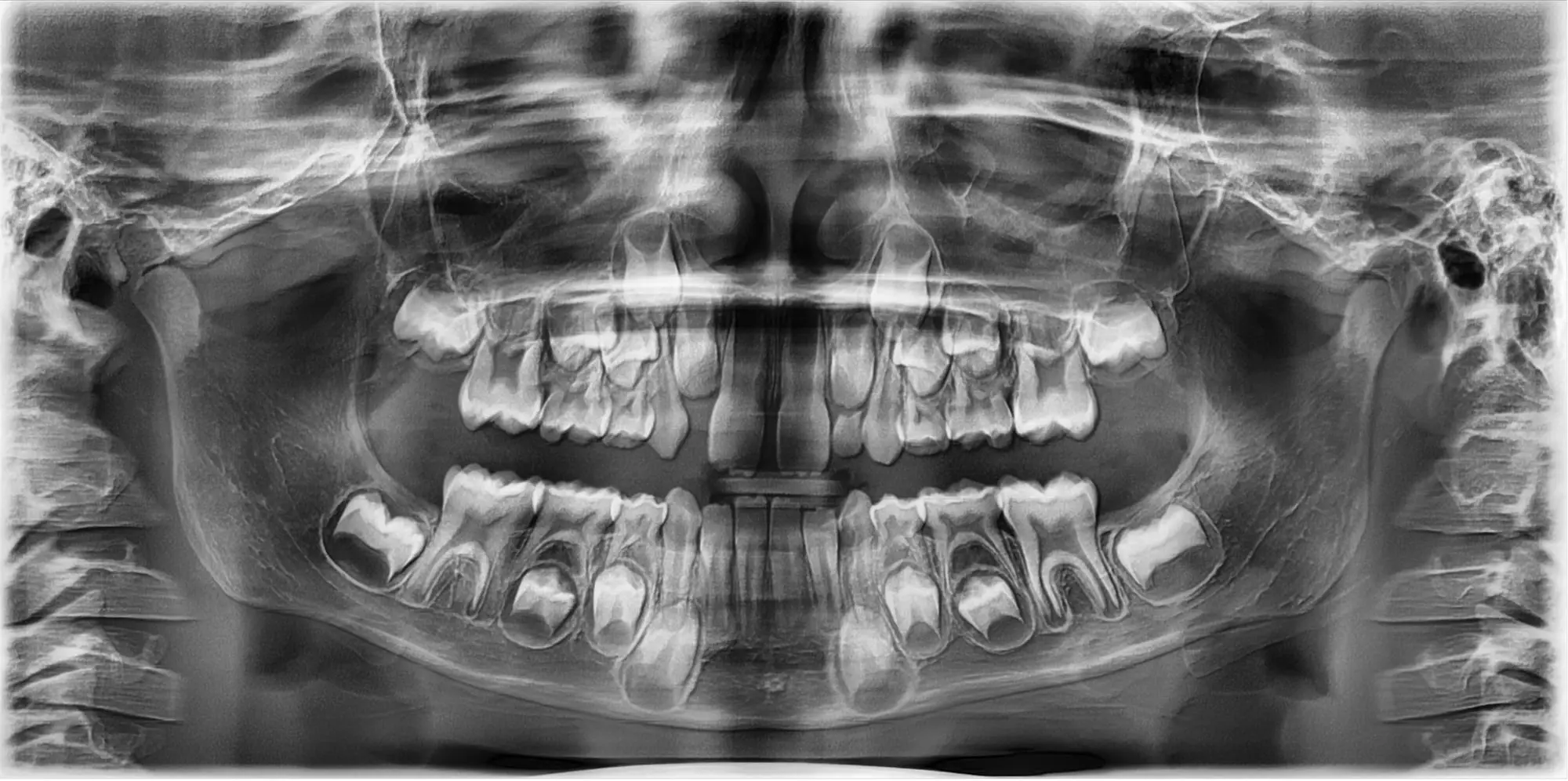 Panoramic dental x-ray showing upper and lower jaw with adult and unerupted permanent teeth, developed using advanced technology for precise imaging at Chauncey Orthodontics Henderson, NV.