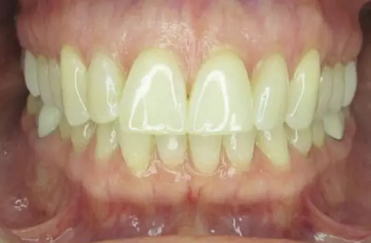 A close-up view of a person's upper and lower teeth before Invisalign, showing healthy gums and slightly crowded lower front teeth.