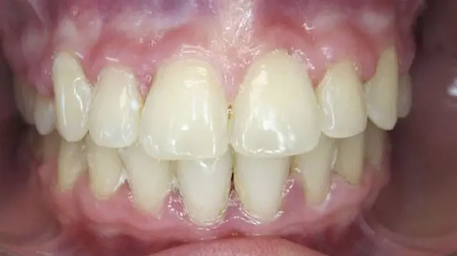 Close-up of a person's teeth after braces, showing mild crowding and overlapping of the upper and lower front teeth with visible gums.