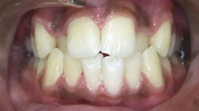 A close-up of a person's mouth before braces, showing misaligned teeth with visible gaps and crowding in both the upper and lower jaws.